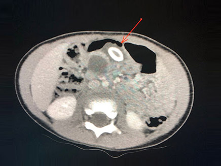 צילום ה-CT של בטן התינוקת (צילום: מרכז שניידר לרפואת ילדים, חדשות)