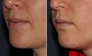 טיפול הרמת פנים בחוטי מינט לפני ואחרי (צילום:  יחסי ציבור )