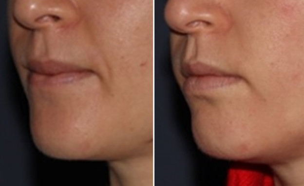 טיפול הרמת פנים בחוטי מינט לפני ואחרי (צילום:  יחסי ציבור )