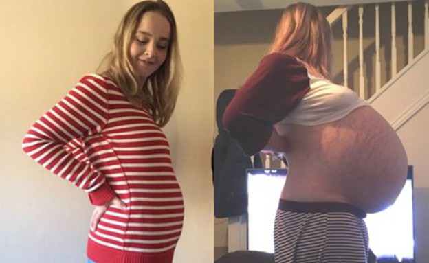 ציסטה בשחלה