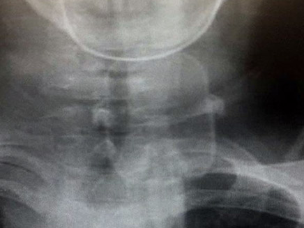 צילום רנטגן של הפקק תקוע בקנה הנשימה (צילום: חדשות)