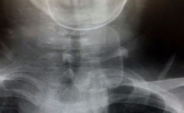 צילום רנטגן של הפקק תקוע בקנה הנשימה (צילום: חדשות)