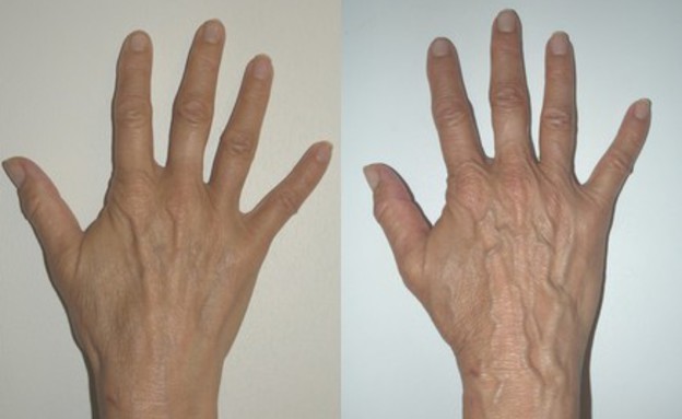 ידיים לפני ואחרי (צילום: סלע מדיקל)