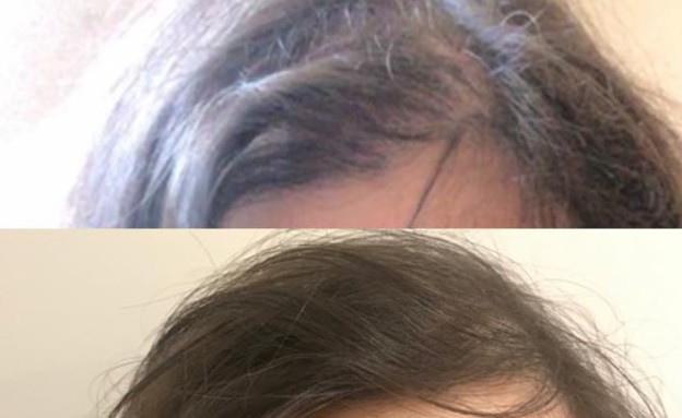 שיער דליל לפני ואחרי