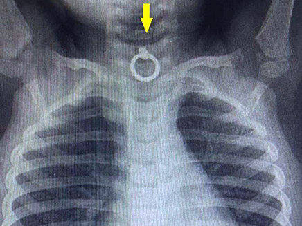 צילום הרנטגן שהדהים את הרופאים (צילום: המרכז הרפואי זיו, חדשות)