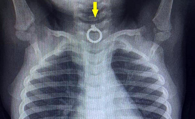צילום הרנטגן שהדהים את הרופאים (צילום: המרכז הרפואי זיו, חדשות)