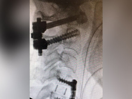 תצלום הרנטגן של פציעת אורליה (צילום: דוברות בית החולים קפלן, חדשות)