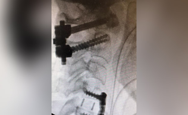 תצלום הרנטגן של פציעת אורליה (צילום: דוברות בית החולים קפלן, חדשות)