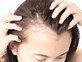 נשירת שיער (צילום:  MRAORAOR, shutterstock)