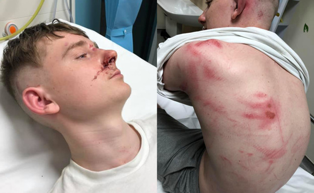 נער הותקף באכזריות בידי קבוצה של עשרה הומופובים (צילום:  Photo by Flash90, פייסבוק)