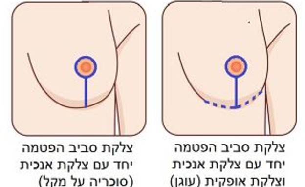 סוגי צלקות (איור: יחצ)