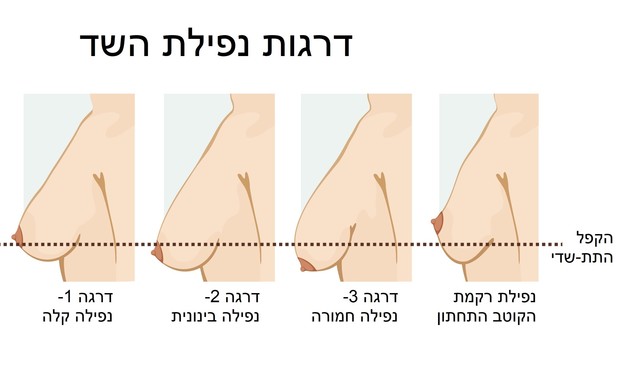 דרגות נפילת החזה עם הסברים (איור: יחצ)