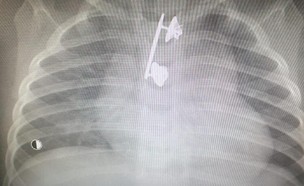 צילום רנטגן: סיכה שנמצאה בוושט של תינוק (צילום: המרכז הרפואי קפלן)