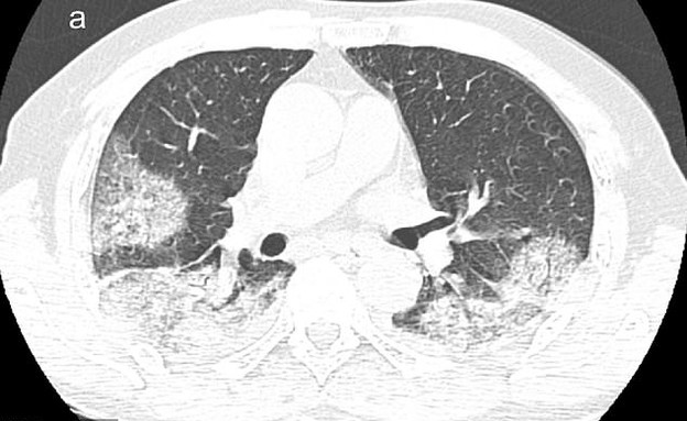 ריאות של חולה קורונה - שלב התחלתי (צילום: Science Direct)