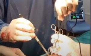 הרופאים נדהמו ממה שמצאו באיבר מינו (צילום: Hazey Cazey Tv youtube)