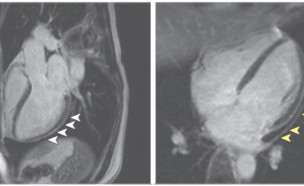 נזקים בלב בעקבות הקורונה (צילום: JAMA Cardiology)