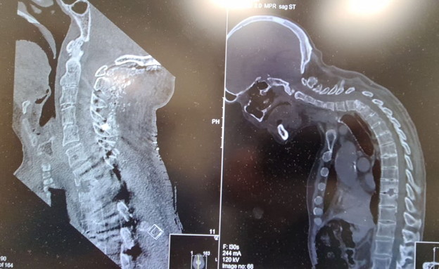 צילום הרנטגן של סאונדרס לפני הניתוח (מימין) ואחריו (צילום: דוברות הלל יפה)