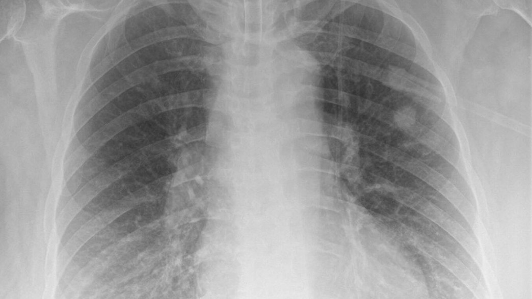 ריאות (צילום: British Medical Journal)