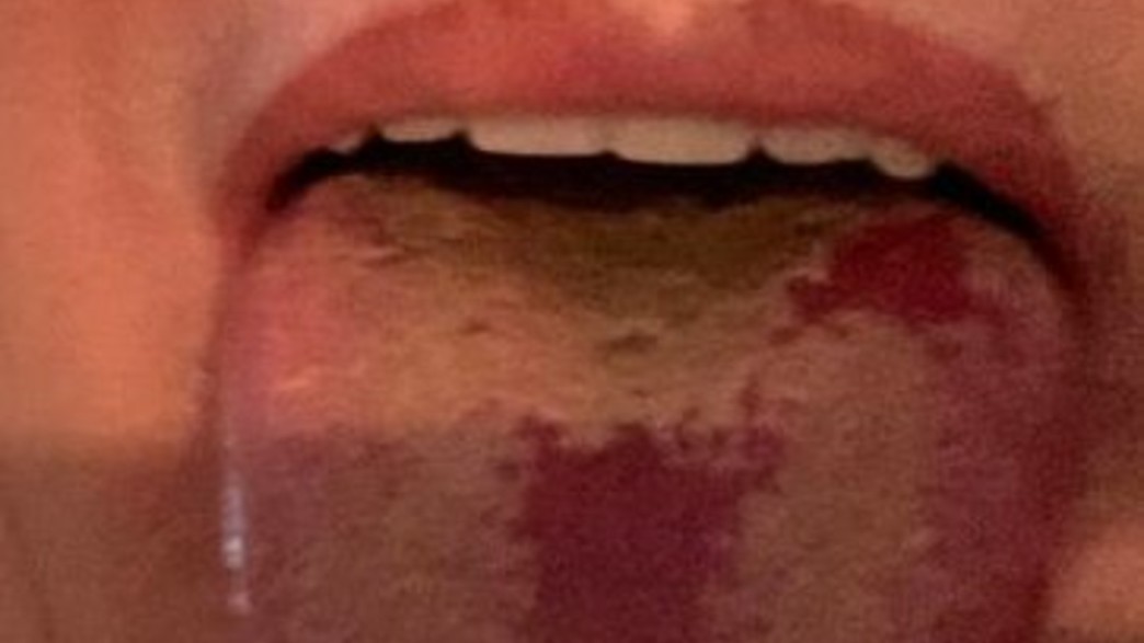 לשון קורונה לשון קורונה