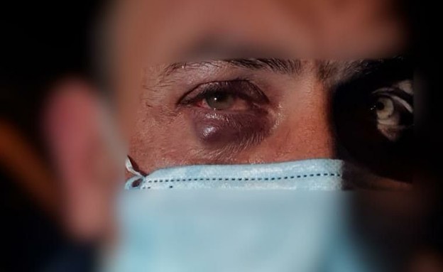 השוטר שנפצע בהפגנת בלפור (צילום: דוברות המשטרה)