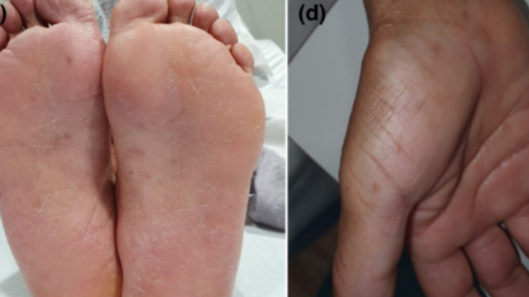 תסמיני קורונה בידיים ורגליים