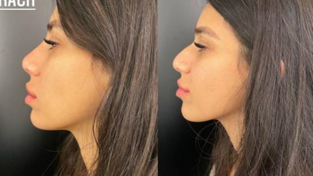 ליאור קוקה פיסלה אף, ינואר 2021