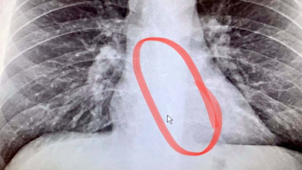 צילום החזה של ברדפורד גוטייר צילום החזה של ברדפורד גוטייר