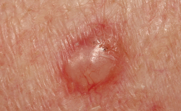 קרצינומה בעור (צילום: Dermatology11, shutterstock)