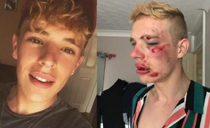 ריאן טרנר, לפני ואחרי התקיפה (צילום: facebook)