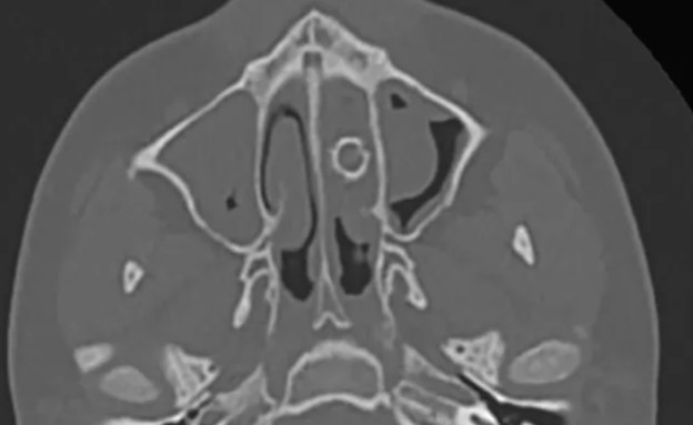 CT אף (צילום: AMA Otolaryngology–Head & Neck Surgery)
