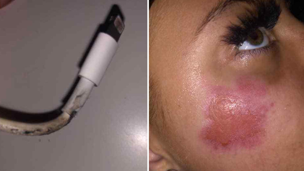 איימי הול נכוותה מאייפון שעלה באש איימי הול נכוותה מאייפון שעלה באש