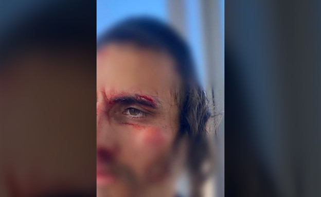 יהודי שהותקף על ידי ערבים באזור שער שכם בירושלים (צילום: דוברות המשטרה)