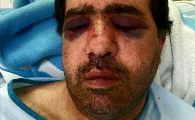 תושב חיפה שהותקף והוכה קשות משחזר (צילום: מתוך "חדשות הבוקר" , קשת12)