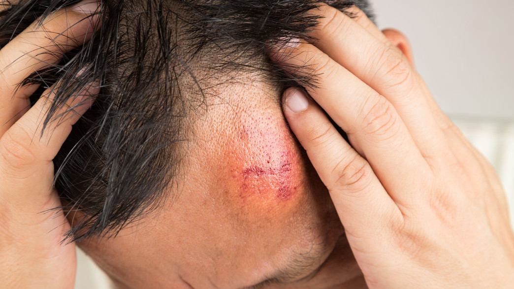 חבלת ראש חבלת ראש