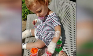 בת שנתיים נכוותה קשה מגחלים בוערות (צילום: מתוך "חדשות הבוקר" , קשת12)