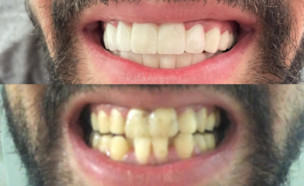 השתלת שיניים (צילום: באדיבות המצולם)