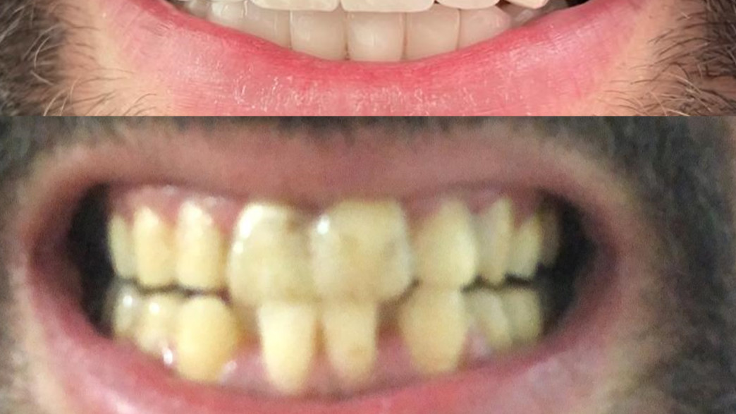 השתלת שיניים