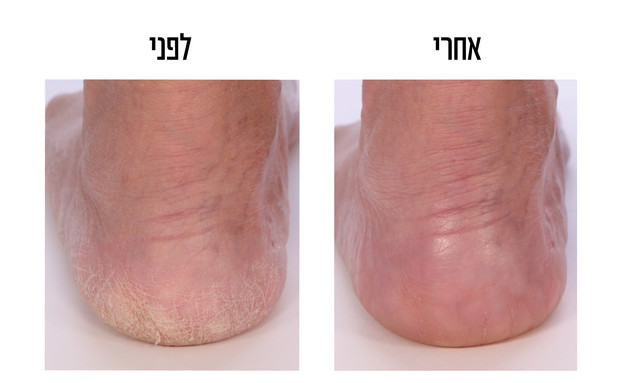 רגליים לפני ואחרי 6 שבועות שימוש בקרם LAVIDO (צילום: יח