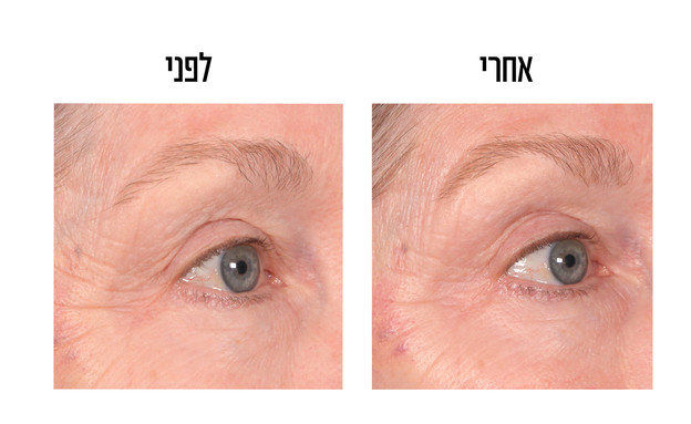 עיניים לפני ואחרי שימוש 6 שבועות בקרם LAVIDO (צילום: יח