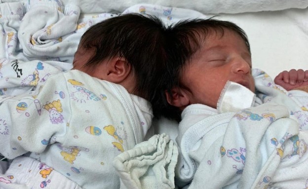 תאומות סיאמיות לפני שהופרדו בניתוח בבית חולים סורוקה (צילום: דובורת בית החולים סורוקה)