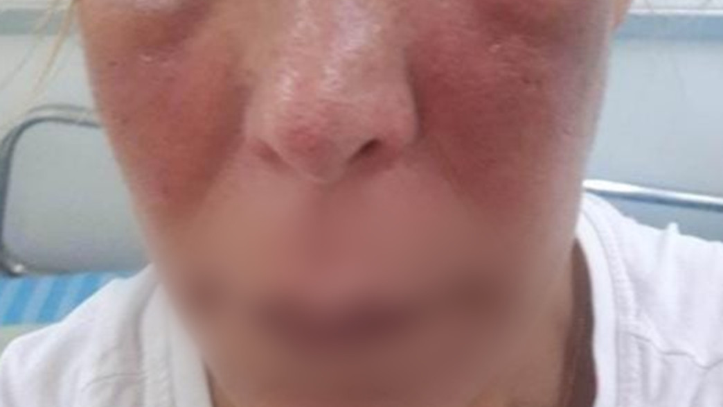 הרופא שכח מחט בסנטר וחטפה זיהום