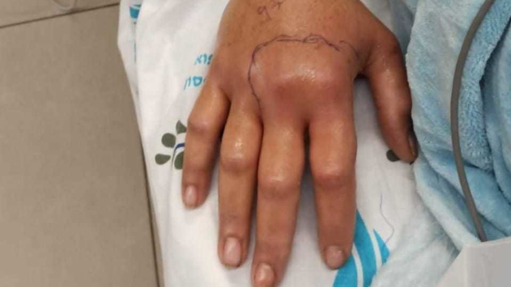 צפע הכיש אישה בראשון לציון