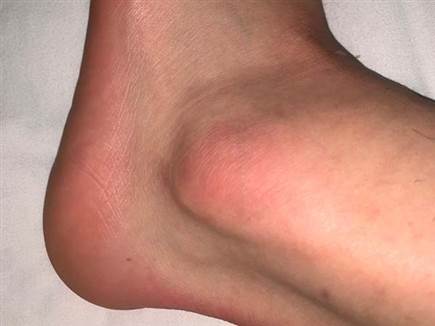 כף הרגל של חזיזה (מתוך חשבון האינסטגרם של דולב חזיזה)