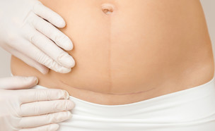 גוף אחרי לידה (צילום: shutterstock by FotoDuets)