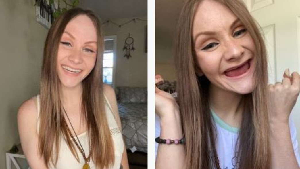 איבדה את השיניים בגיל 23