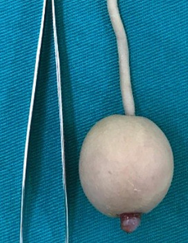 תינוק נולד עם זנב באורך 12 ס"מ (צילום: Journal of Pediatric Surgery Case Reports)