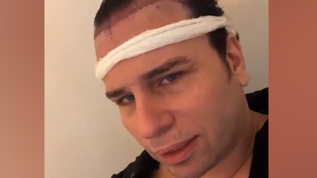 סקאזי השתיל שיער בטורקיה – וככה זה נראה סקאזי השתיל שיער בטורקיה – וככה זה נראה