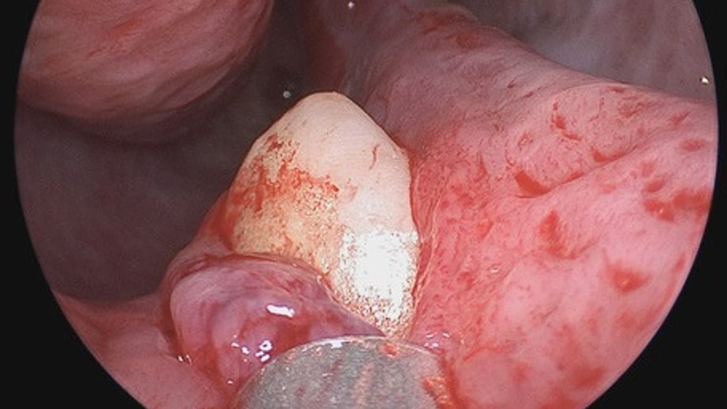 שן צמחה בתוך אף