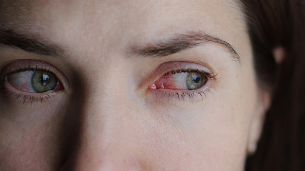 עיניים אדומות (צילום: Domaskina, Shutterstock)