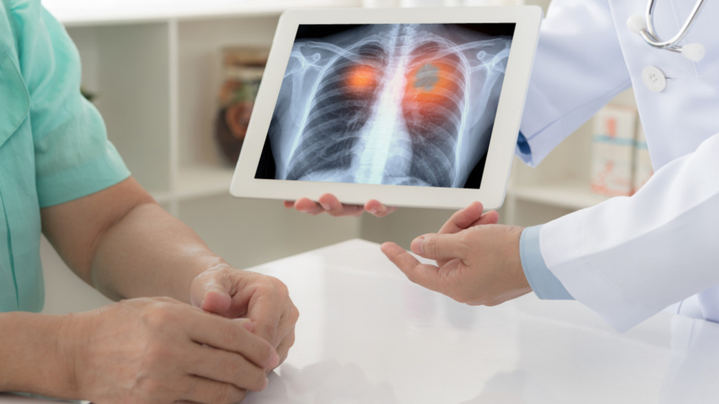 סרטן ריאה סרטן ריאה